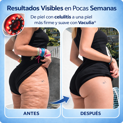 Vaculia® Masajeador Anticelulitis con Luz Roja y Azul