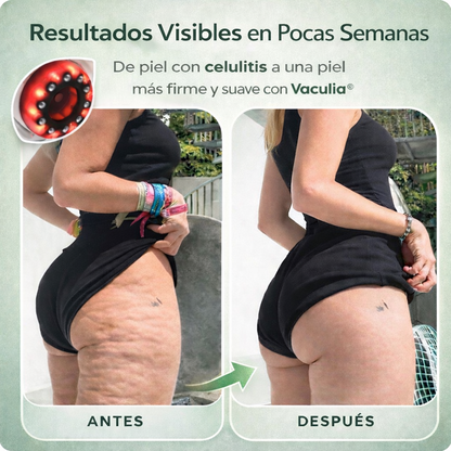 Vaculia™ Masajeador Anticelulitis
